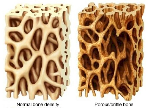 Osteoporosis linked with heart disease in older people 
